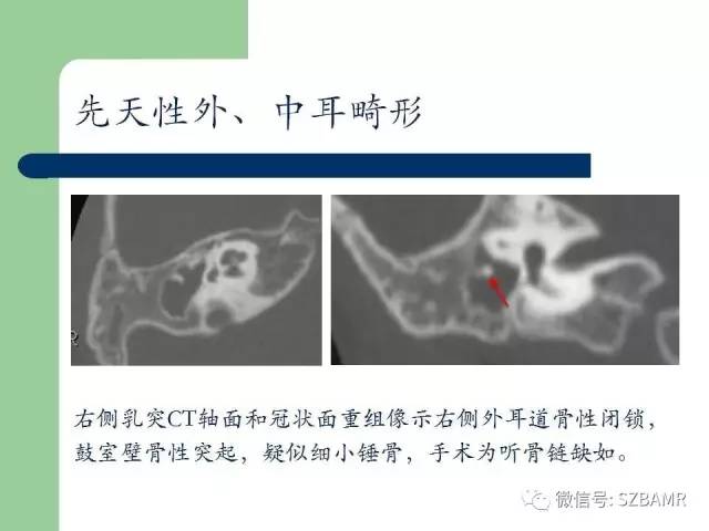 【PPT】外中耳解剖及变异畸形CT表现