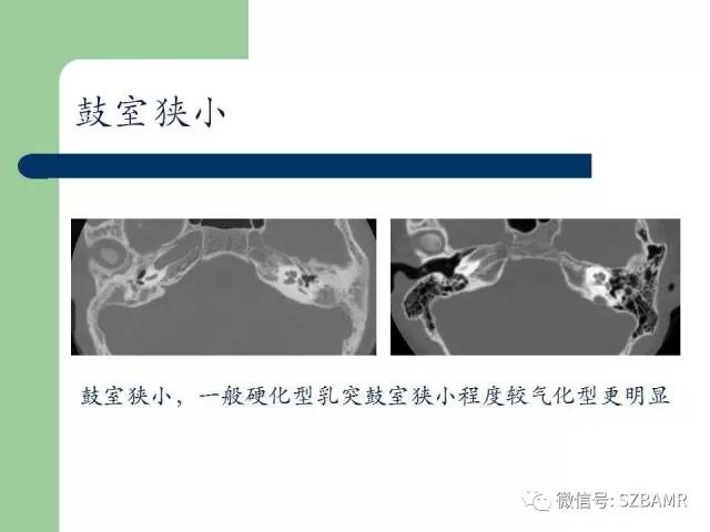 【PPT】外中耳解剖及变异畸形CT表现