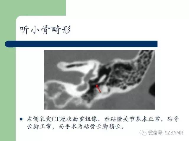 【PPT】外中耳解剖及变异畸形CT表现
