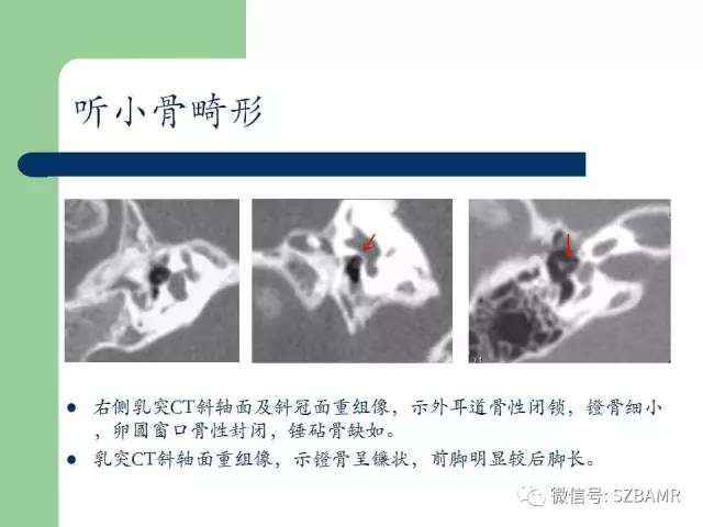 【PPT】外中耳解剖及变异畸形CT表现