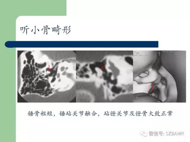【PPT】外中耳解剖及变异畸形CT表现
