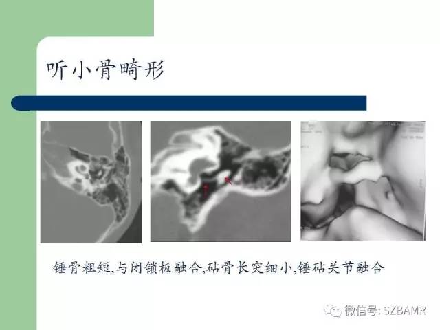 【PPT】外中耳解剖及变异畸形CT表现