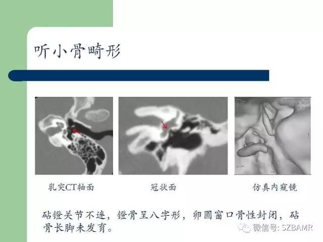 【PPT】外中耳解剖及变异畸形CT表现