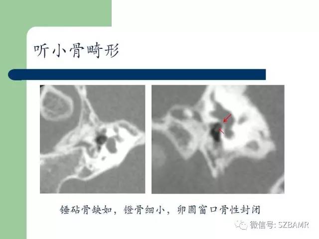 【PPT】外中耳解剖及变异畸形CT表现