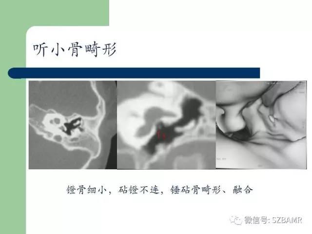 【PPT】外中耳解剖及变异畸形CT表现