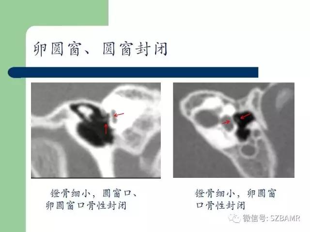 【PPT】外中耳解剖及变异畸形CT表现