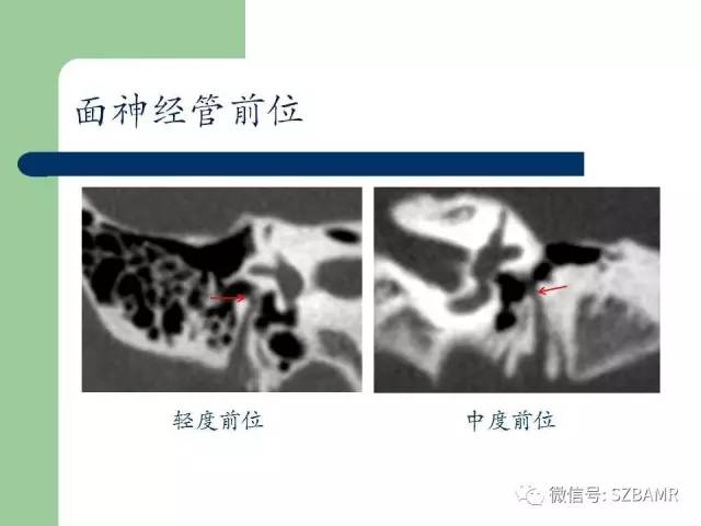 【PPT】外中耳解剖及变异畸形CT表现