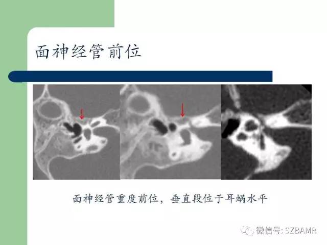 【PPT】外中耳解剖及变异畸形CT表现