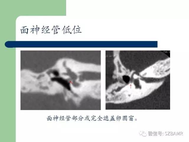 【PPT】外中耳解剖及变异畸形CT表现