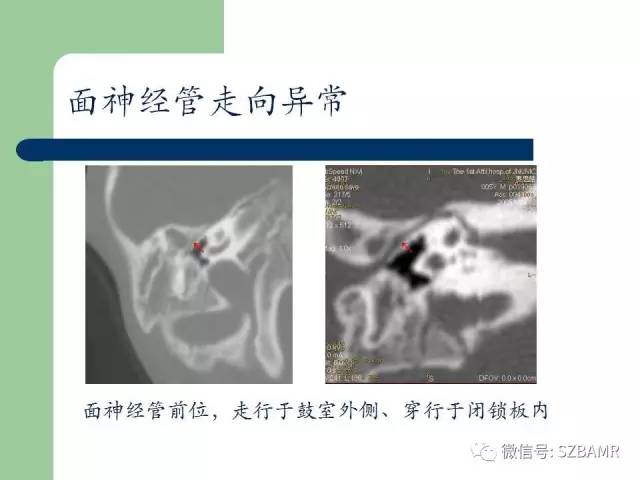 【PPT】外中耳解剖及变异畸形CT表现
