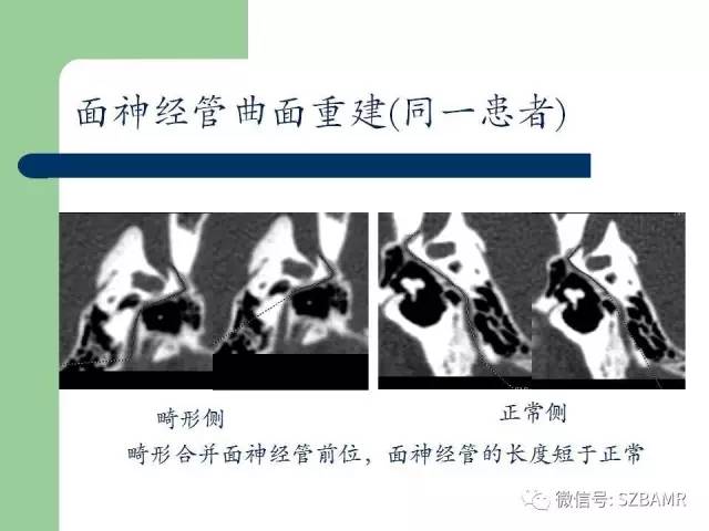 【PPT】外中耳解剖及变异畸形CT表现