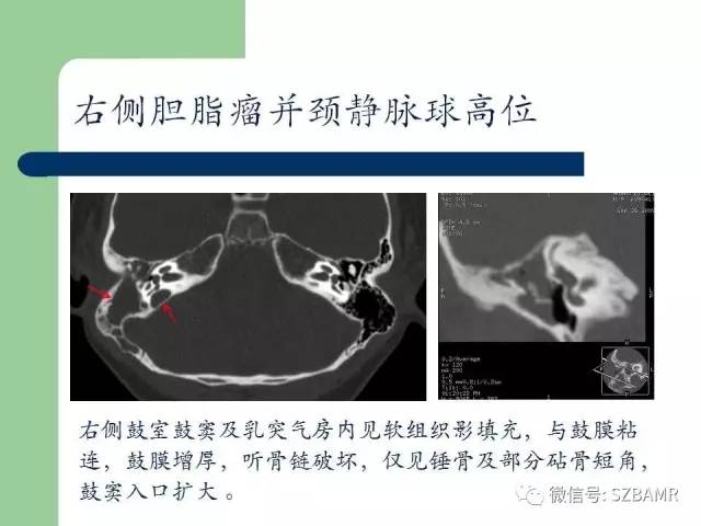 【PPT】外中耳解剖及变异畸形CT表现
