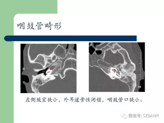 【PPT】外中耳解剖及变异畸形CT表现