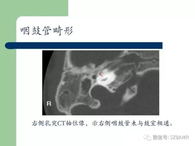 【PPT】外中耳解剖及变异畸形CT表现