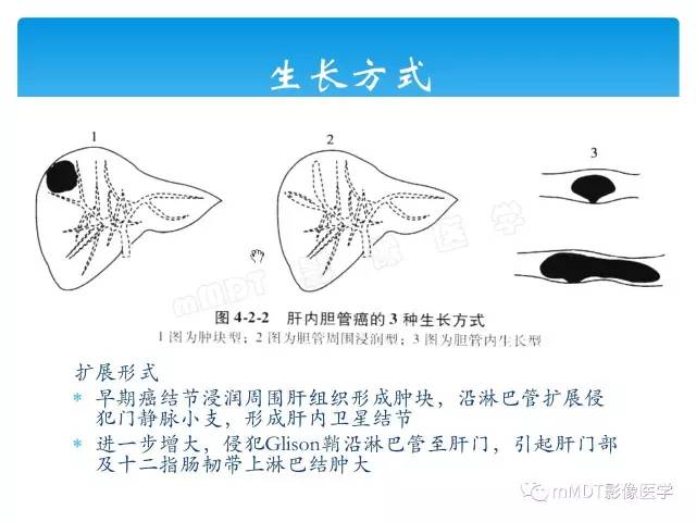【PPT】胆管细胞癌