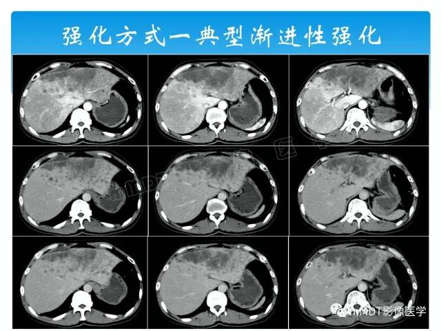 【PPT】胆管细胞癌
