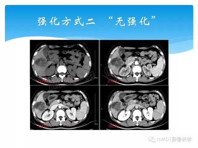 【PPT】胆管细胞癌