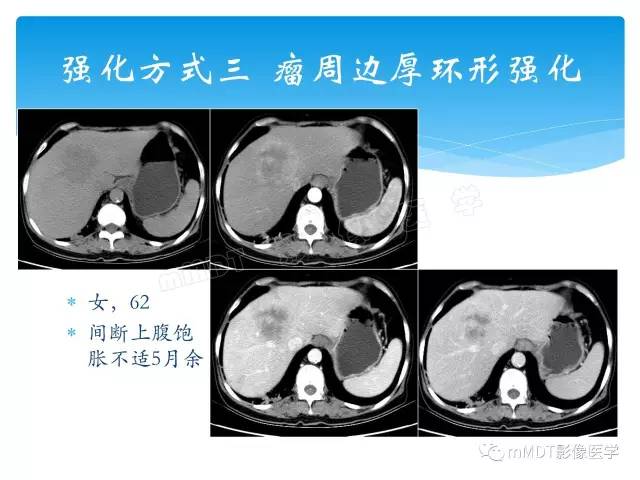 【PPT】胆管细胞癌