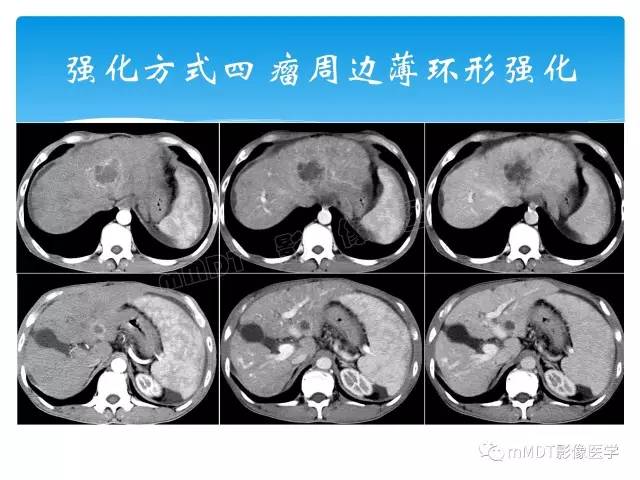【PPT】胆管细胞癌