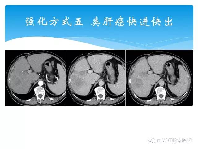 【PPT】胆管细胞癌