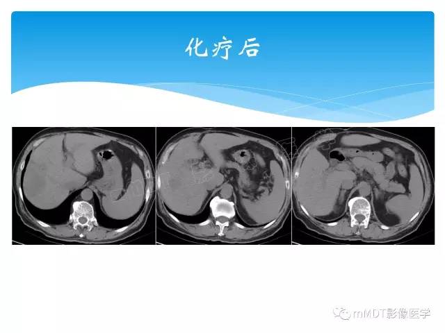 【PPT】胆管细胞癌