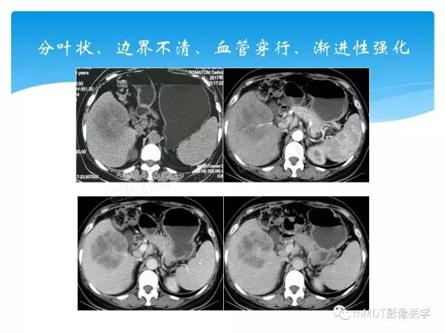 【PPT】胆管细胞癌