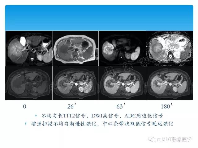 【PPT】胆管细胞癌