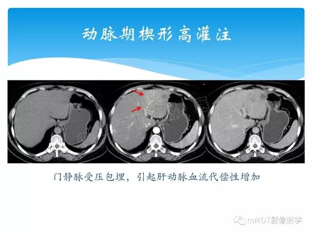 【PPT】胆管细胞癌