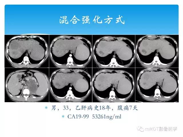 【PPT】胆管细胞癌