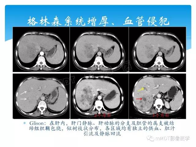 【PPT】胆管细胞癌