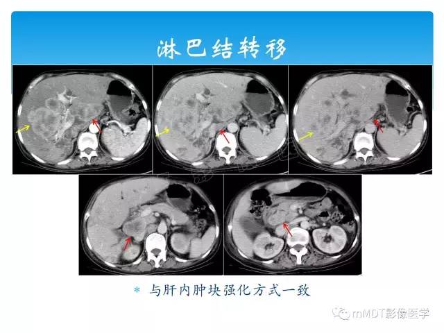【PPT】胆管细胞癌