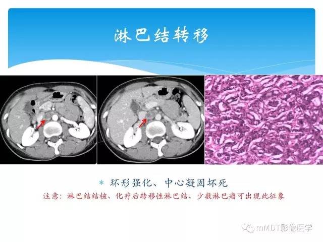 【PPT】胆管细胞癌