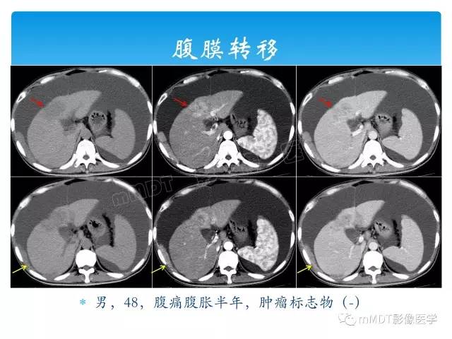 【PPT】胆管细胞癌