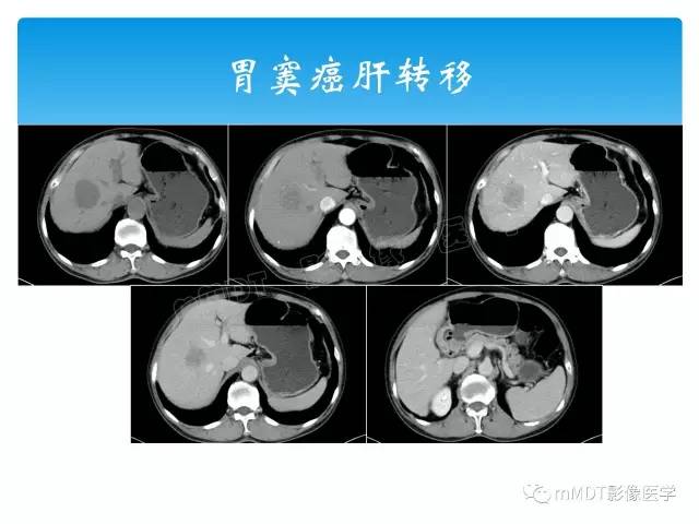 【PPT】胆管细胞癌