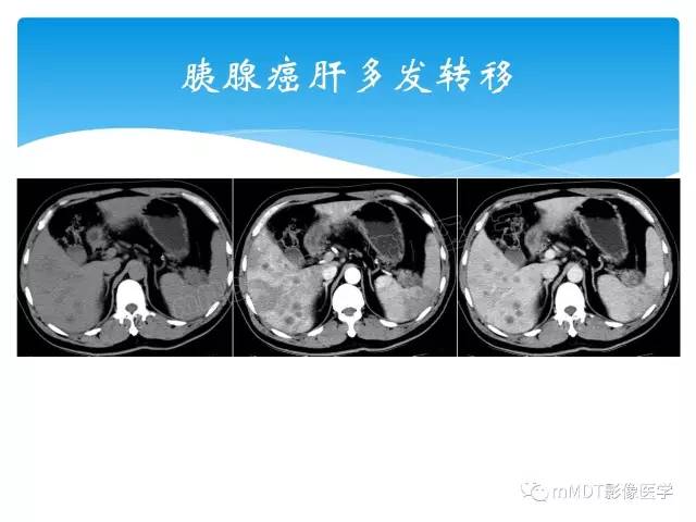 【PPT】胆管细胞癌