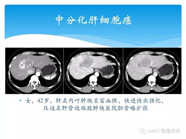 【PPT】胆管细胞癌