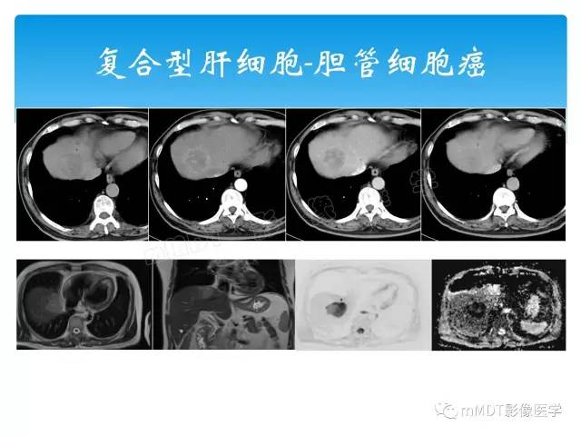【PPT】胆管细胞癌