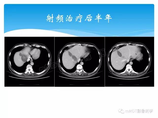 【PPT】胆管细胞癌