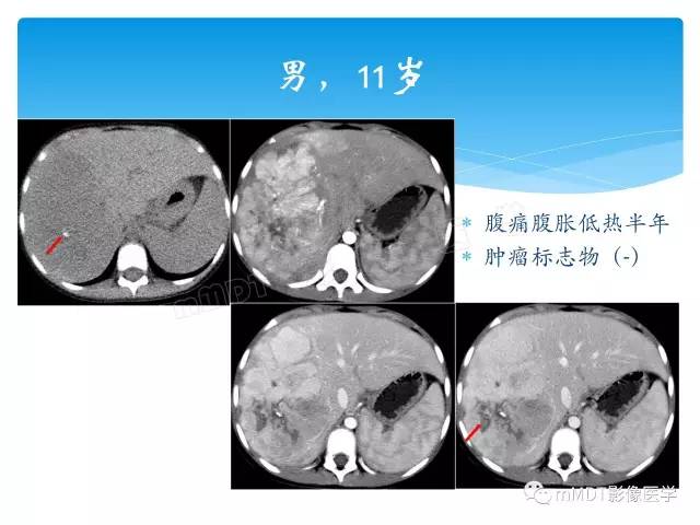 【PPT】胆管细胞癌