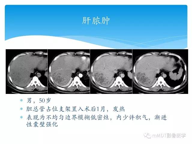 【PPT】胆管细胞癌