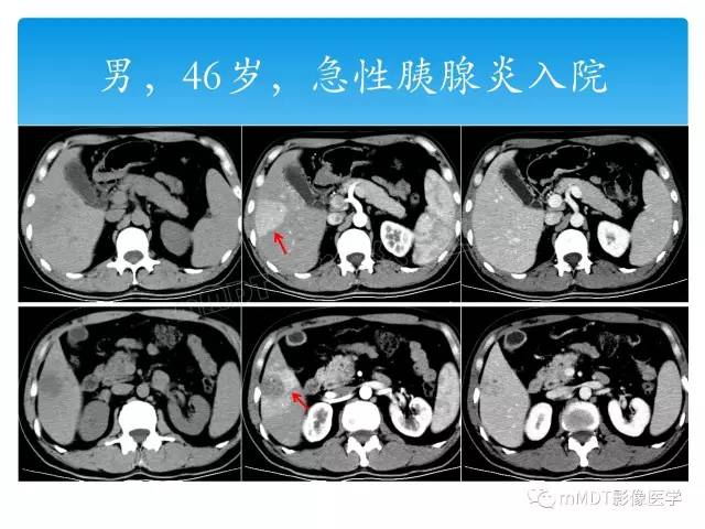 【PPT】胆管细胞癌