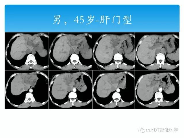 【PPT】胆管细胞癌