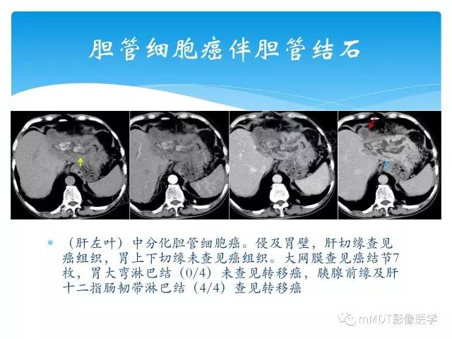 【PPT】胆管细胞癌