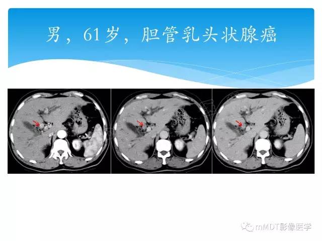 【PPT】胆管细胞癌