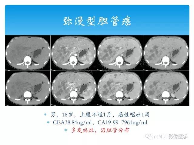 【PPT】胆管细胞癌