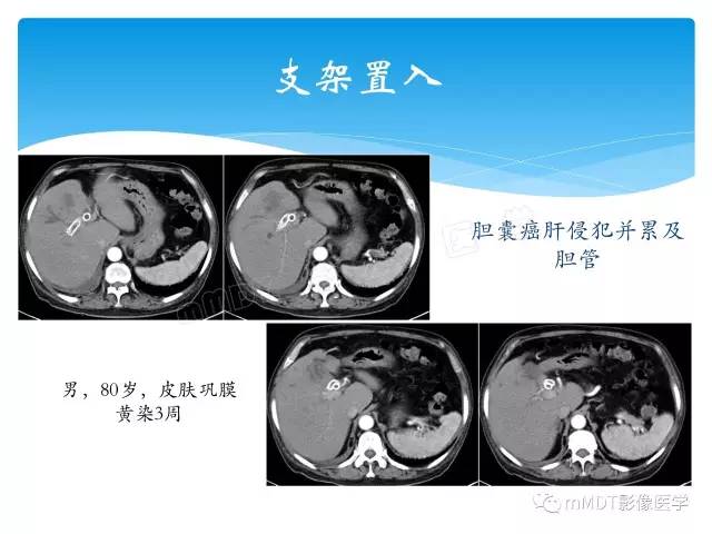 【PPT】胆管细胞癌