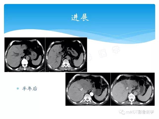 【PPT】胆管细胞癌