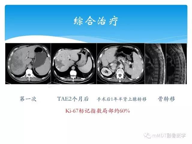 【PPT】胆管细胞癌
