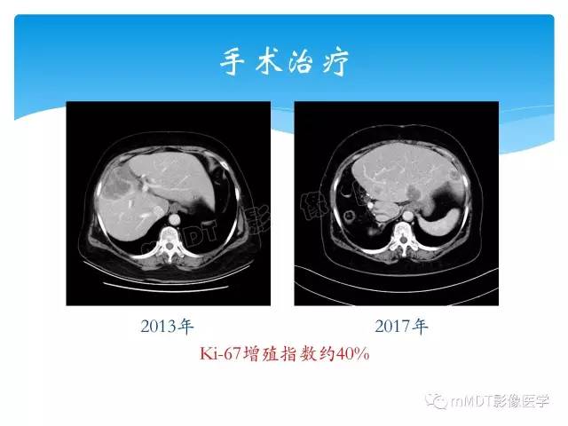 【PPT】胆管细胞癌
