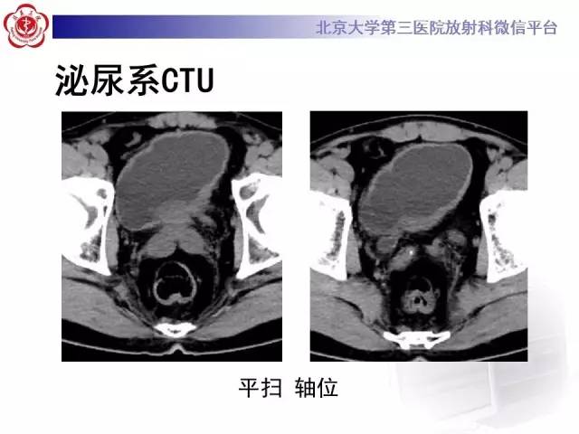 【病例】腺性膀胱炎1例CT影像表现与鉴别